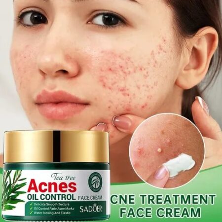 Crema Para El Tratamiento Del Acné. SADOER